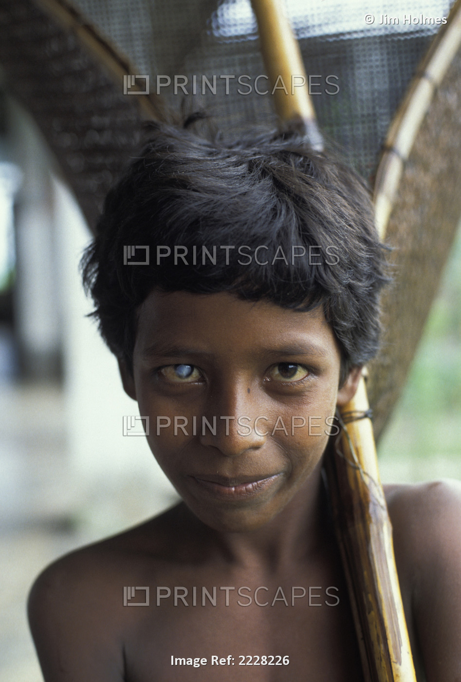 Bangladesh, Boy With Cataract; Khulna