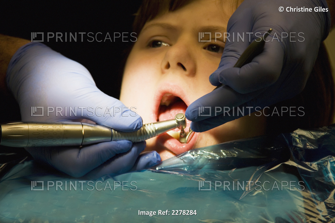 A girl undergoing treatment at the dentist's office; Whitley bay tyne and wear ...