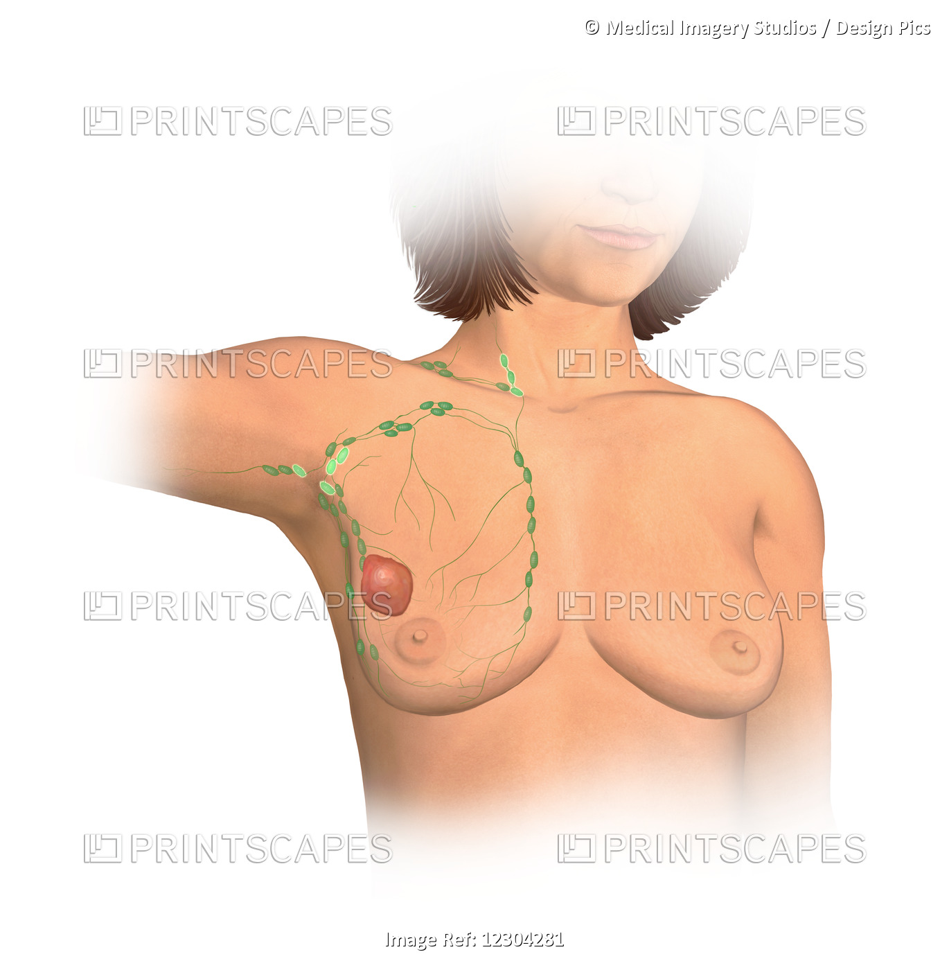 Anterior View Female Anatomy Showing Breast Tissue With A Tumor, Stage Three ...